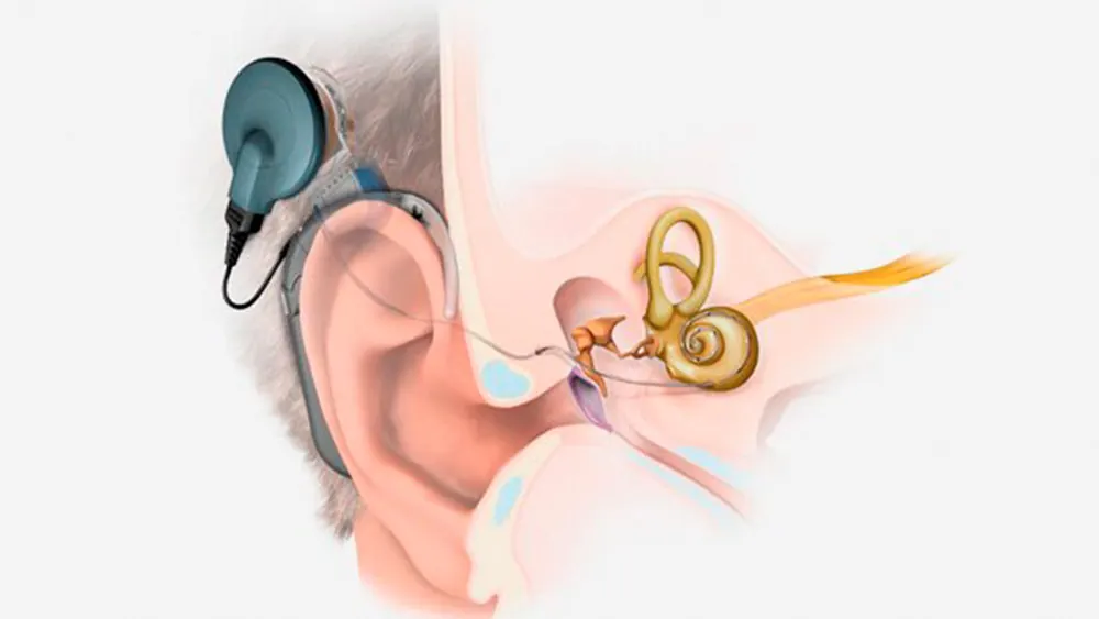 Implante Coclear: o que é, como funciona, indicações e cirurgia do ouvido biônico