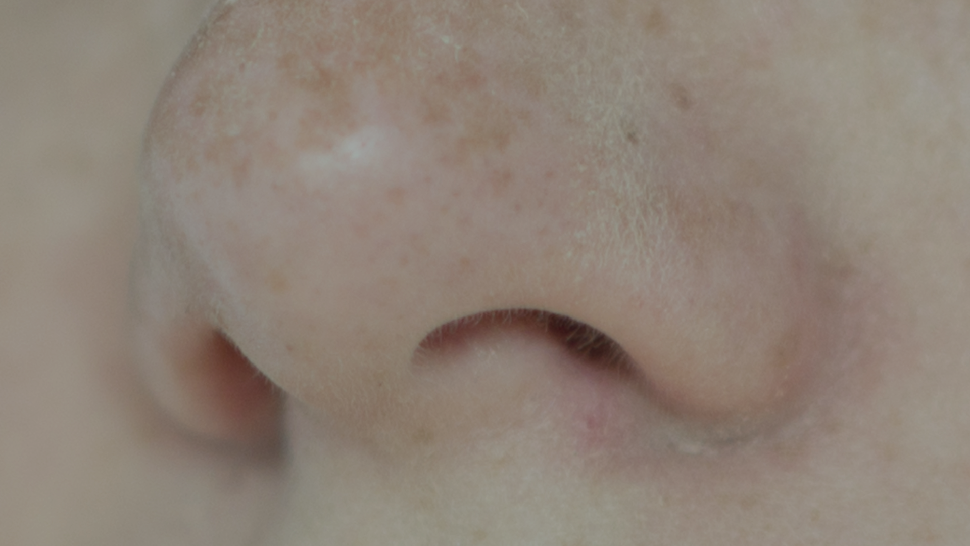 Septoplastia (Correção de Desvio de Septo) | Dr. Lucas